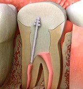 Root Canal (Endodontist)