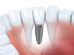 How Much do Dental Implants Cost in Morrisville? 