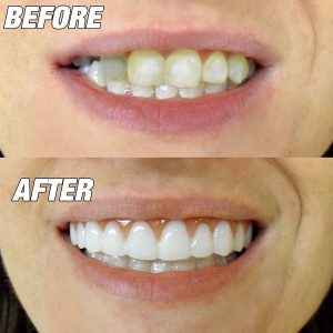 How Veneers Can Fix Your Teeth