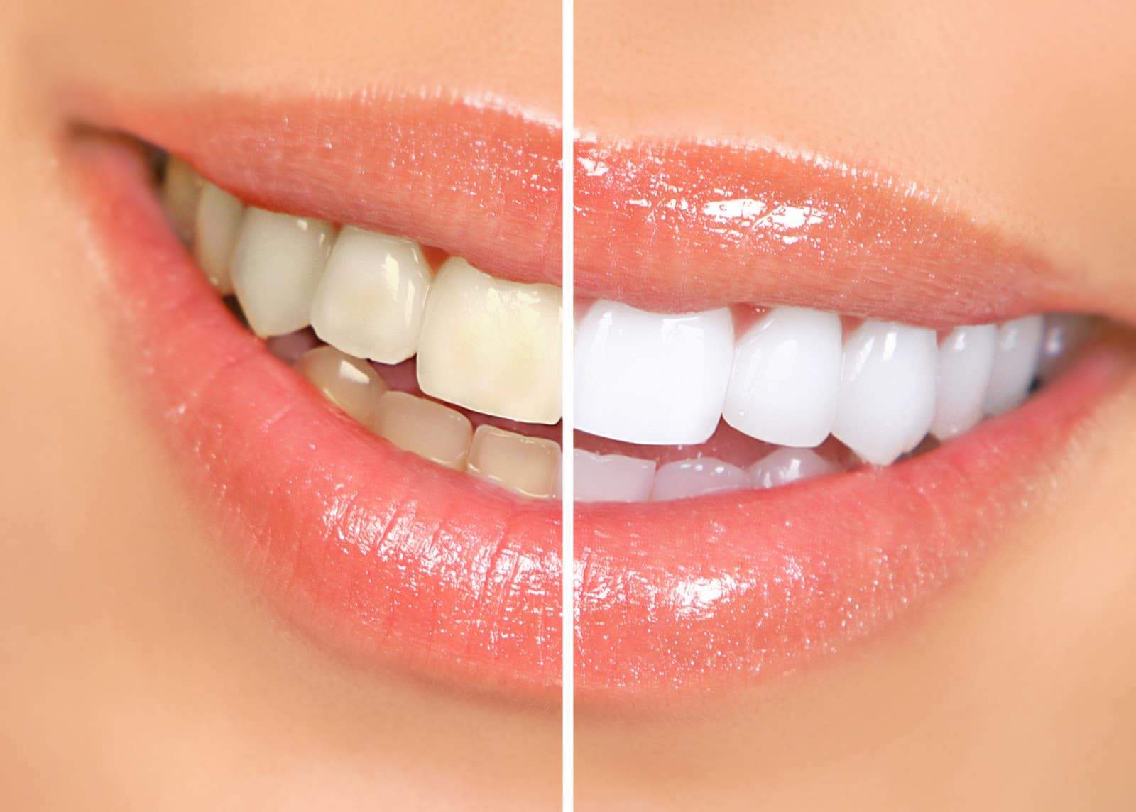 Teeth Whitening and Bleaching