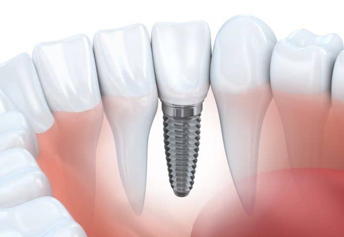 How Much do Dental Implants Cost in Morrisville?