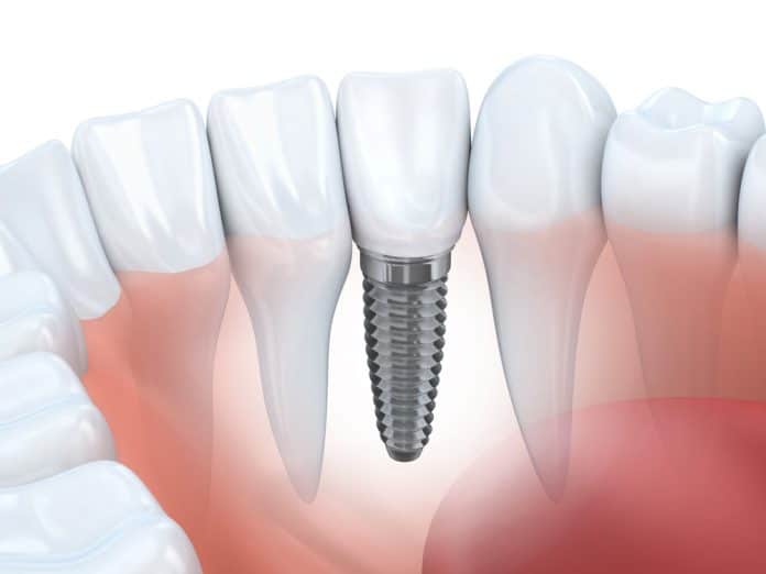 How Much do Dental Implants Cost in Morrisville?