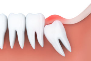 6 Signs You Need to Get Your Wisdom Teeth Removed 